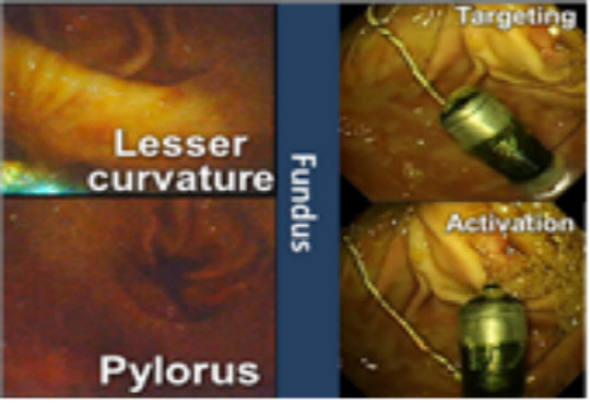 돼지실험에서 자기장 기반의 캡슐내시경으로 영상진단과 미생물 채취를 하고 있다<한국과학기자협회 제공>